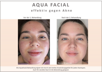 Aqua Facial Nathalie Reich effektiv gegen Akne