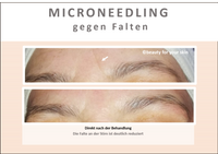 Beauty for your Skin Microneedling Folie 10 f&uuml;r Video by Beauty for your SKin