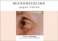Beauty for your Skin Microneedling Folie 3 f&uuml;r Video by Beauty for your SKin