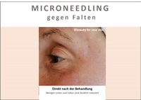 Beauty for your Skin Microneedling Folie 4 f&uuml;r Video by Beauty for your SKin