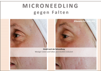 Beauty for your Skin Microneedling Folie 5 f&uuml;r Video by Beauty for your SKin