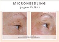 Beauty for your Skin Microneedling Folie 5-2 f&uuml;r Video by Beauty for your SKin
