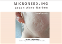 Beauty for your Skin Microneedling Folie 6 f&uuml;r Video by Beauty for your SKin