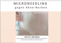 Beauty for your Skin Microneedling Folie 7 f&uuml;r Video by Beauty for your SKin