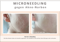 Beauty for your Skin Microneedling Folie 8 f&uuml;r Video by Beauty for your SKin