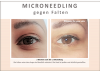 Beauty for your Skin Microneedling Folie 9 f&uuml;r Video by Beauty for your SKin