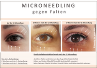 Microneedling Falten Jana Auge 1,2 und 3. Behandlung_1